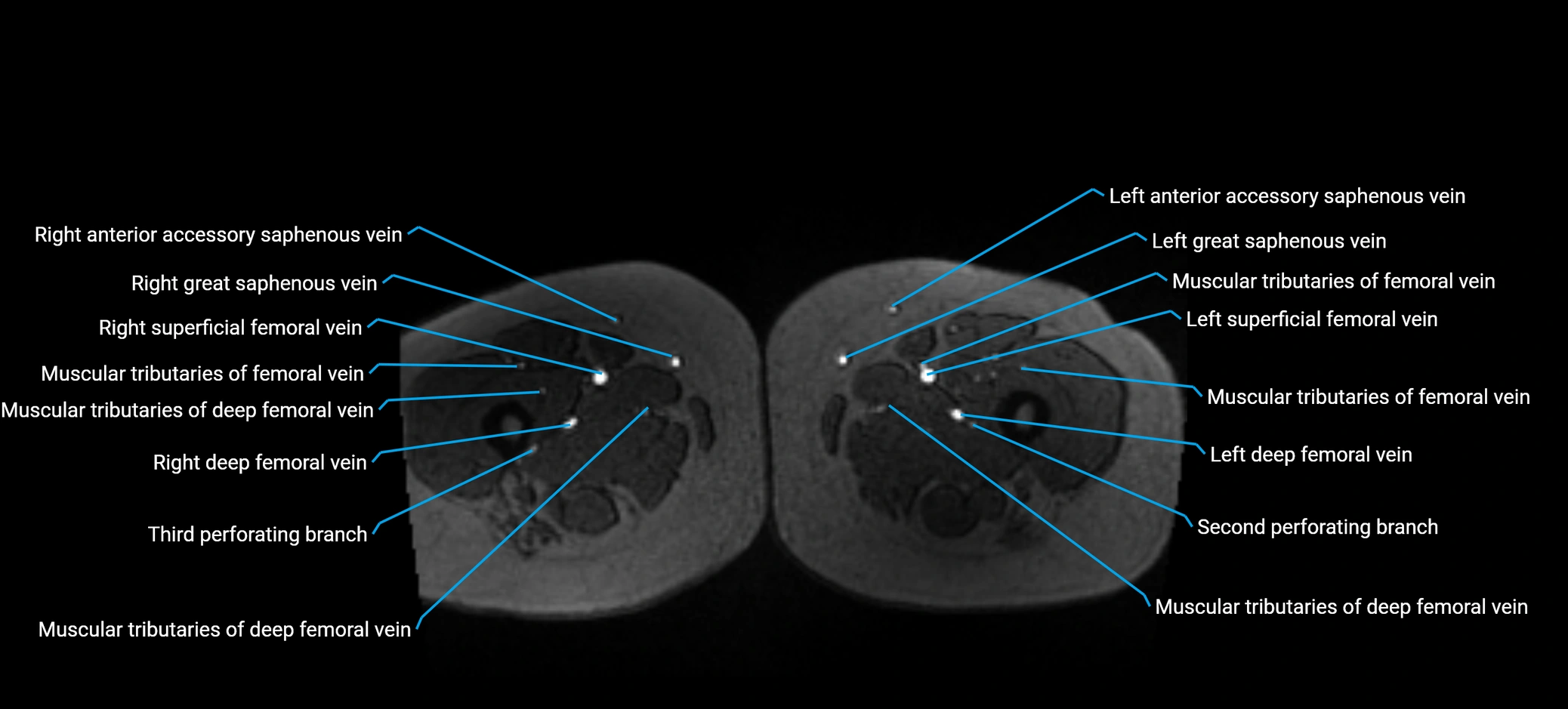 MRV abdomen pelvis & lower limb axial cross sectional anatomy labelled MRI image 240 (1).webp